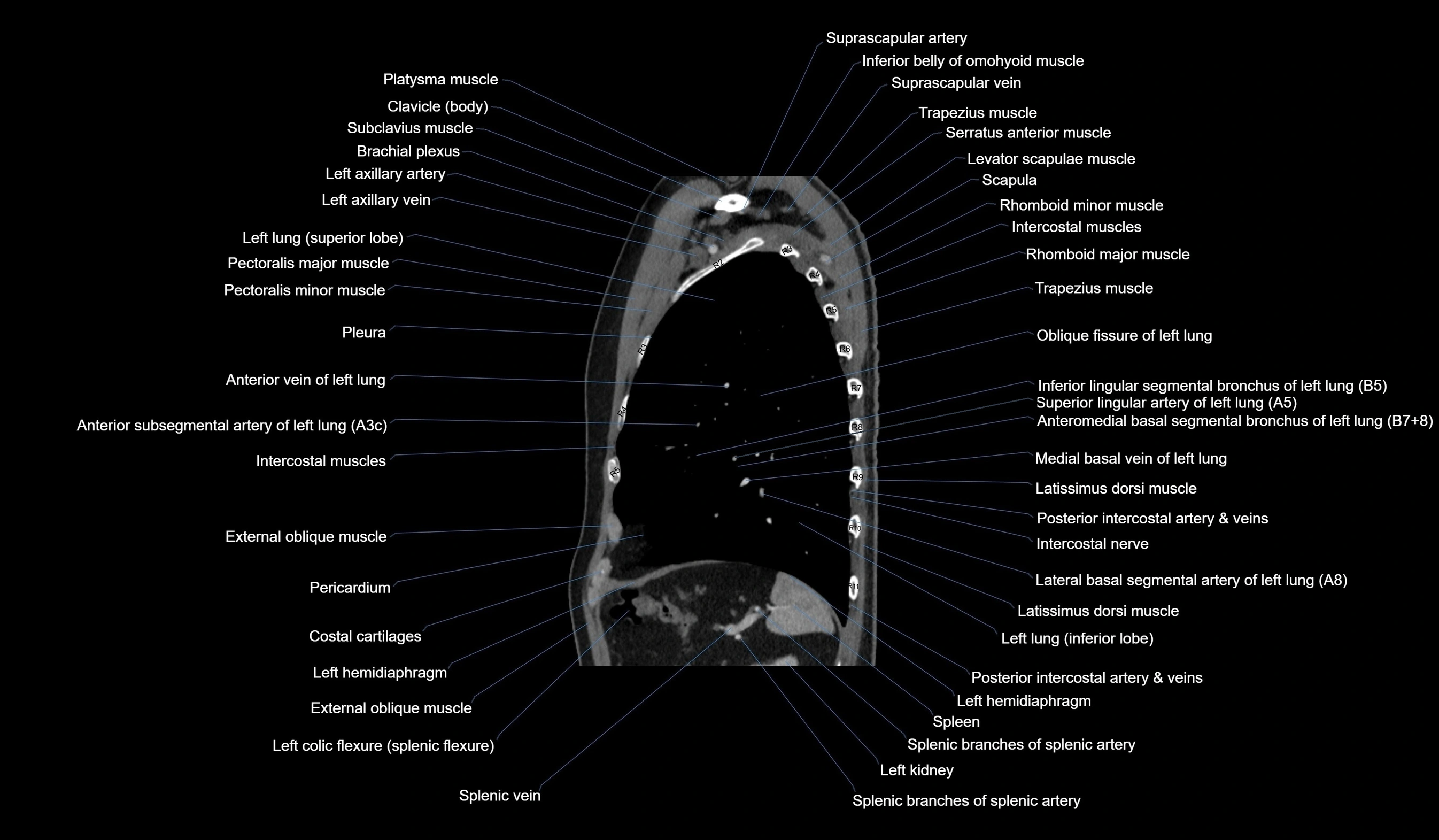 CT chest (thorax) soft tissue window labelled sagittal cross sectional anatomy radiology image-00107.webp